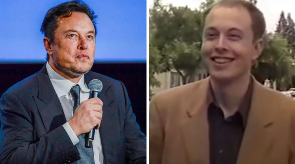 elon musk hair transplant