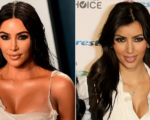 Kim Kardashian Before and After Plastic Surgery Journey