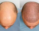 esthetismhealth--Hair Follicle Surgery