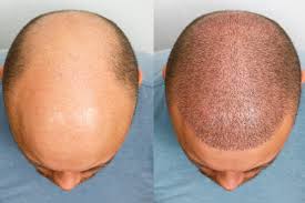 esthetismhealth--Hair Follicle Surgery